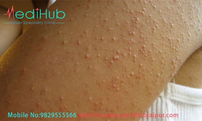 best allergy specialist in jaipur