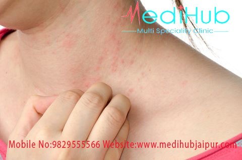 best allergy specialist in jaipur