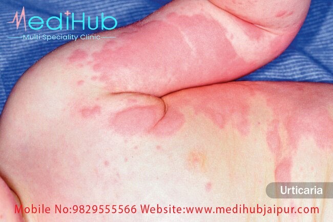 Allergy specialist in jaipur