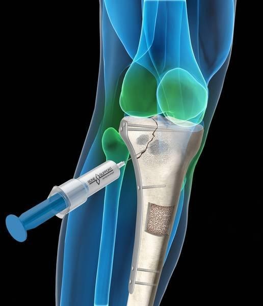 Bone Grafts and Substitutes Market