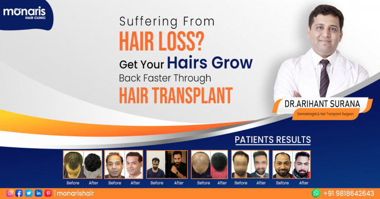 Hair Transplant in Delhi - Dr. Arihant Surana - Monaris Hair Clinic