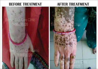 Natural Treatment for Vitiligo