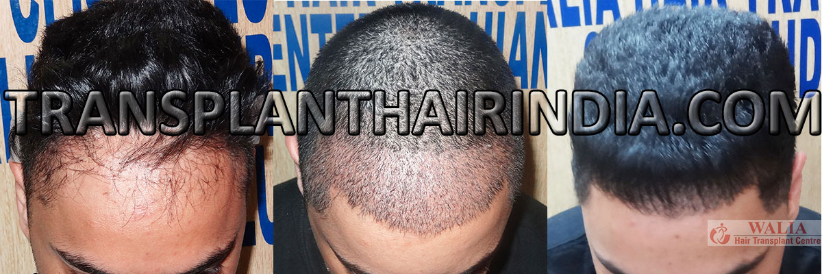 Hair transplant in India by low cost FUE minor surgeries