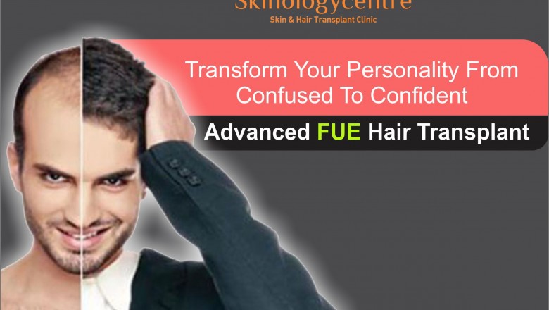 Hair Transplant | Hair Transplant in Bangalore | FUE Hair Transplant Cost in Bangalore | Beard & Moustache Transplant