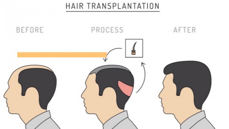 Do you know the early warning signs of male pattern baldness