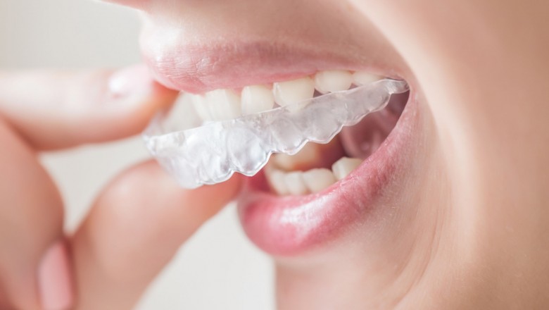 Dental Implant cost in Bhopal