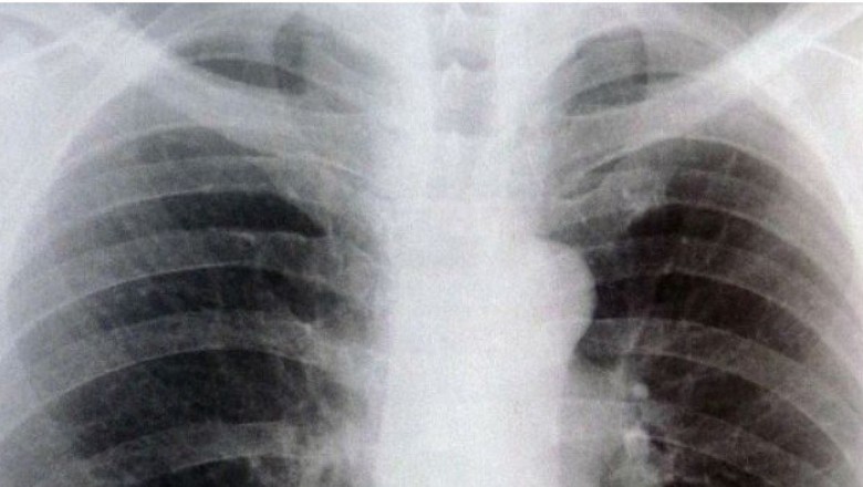 Chest X-rays Prior to Surgery