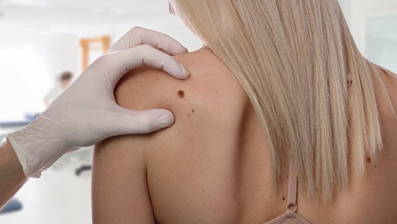 Skin Tag Removal Treatment