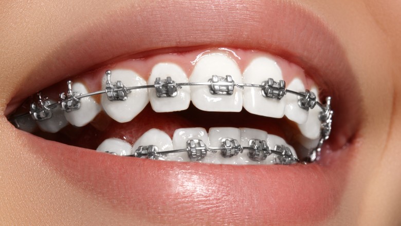 Ways to Stop Braces Pain