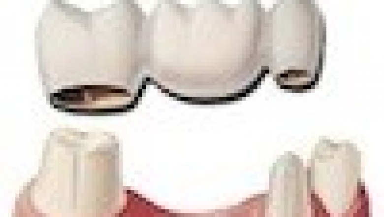 Teeth Bridge Cost Philippines