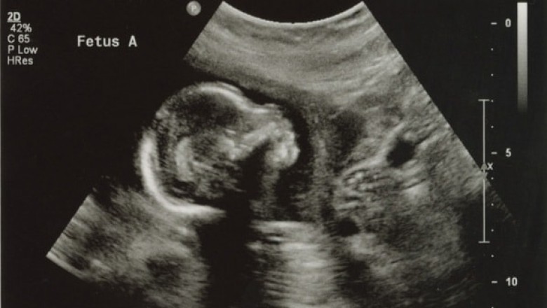 level 2 ultrasound in pregnancy