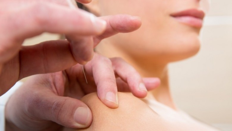 Acupuncture treatment services at Care2Cure physiotherapy Center Ottawa