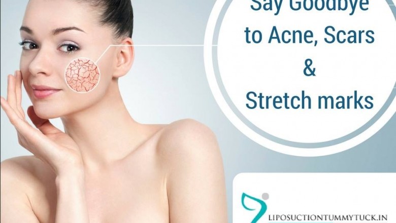 Chemical Peel for Acne in Cardiff