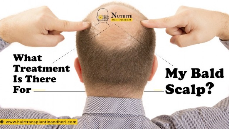What Treatment Is There For My Bald Scalp?