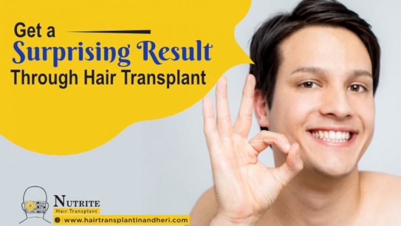 Get a Surprising Result through Hair Transplant