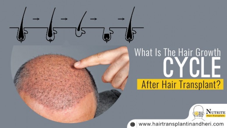 What Is The Hair Growth Circle After Hair Transplant?