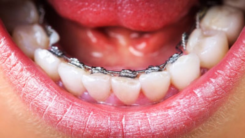 Best Dental Braces Treatment Provider in Ahmedabad, India