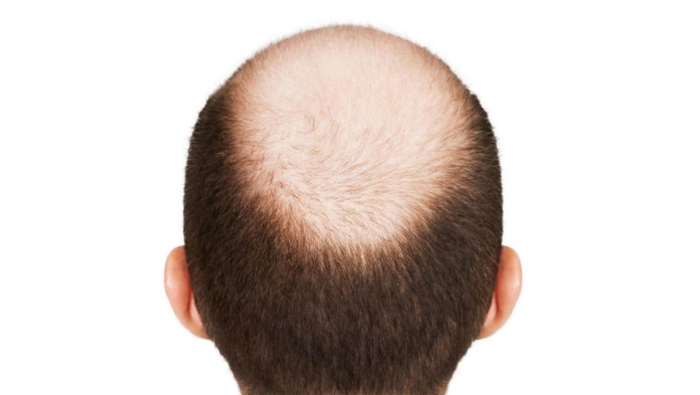 hair transplant in coimbatore