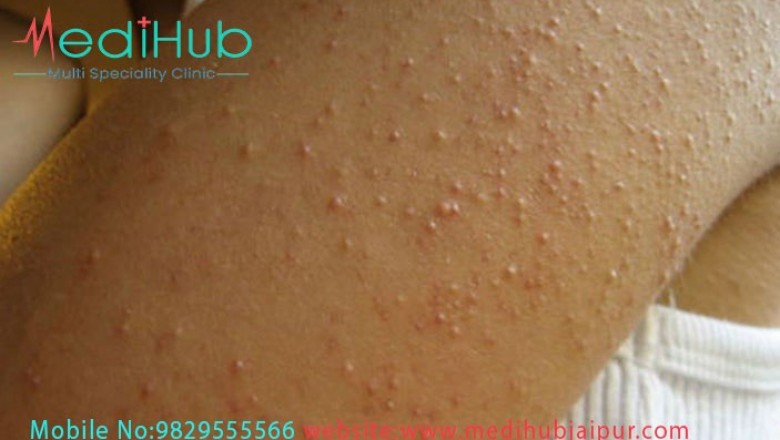 Best Allergy Specialist in Jaipur | MediHub Clinic