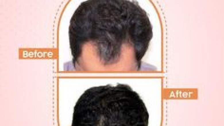 Dealing with bald scalp: How To Restore It?