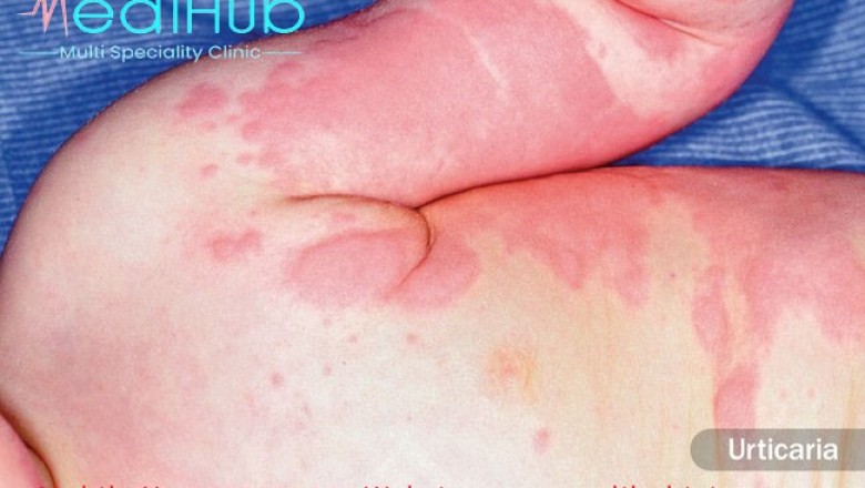 Allergy specialist in jaipur  | MEDIHUB