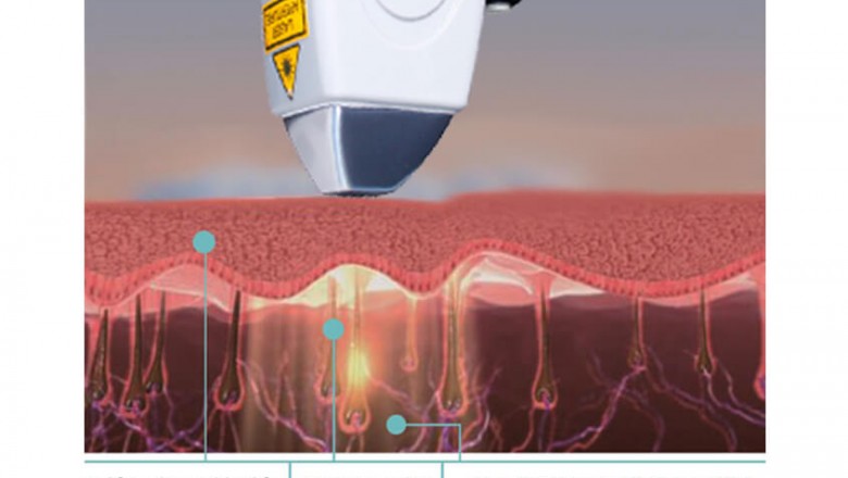 medical laser supplier