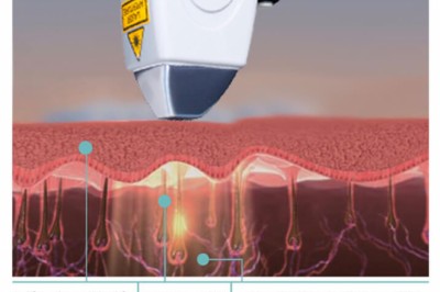 medical laser supplier