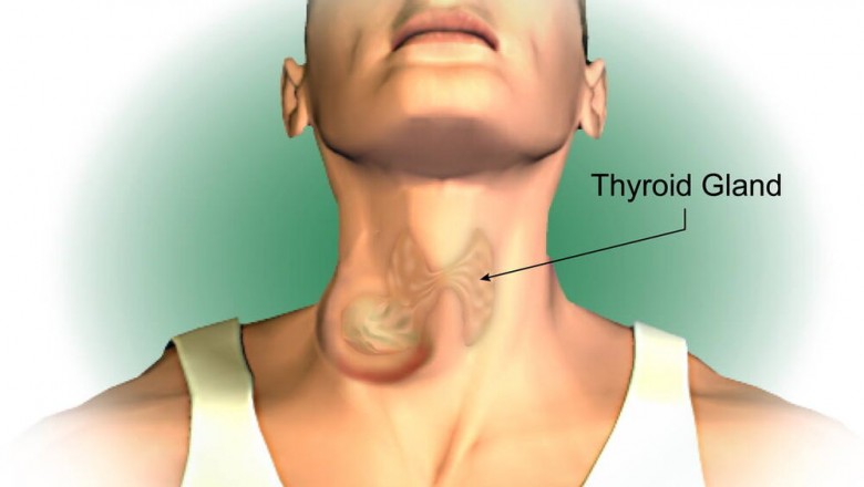 Thyroid Cancer: Symptoms, Causes and Treatment