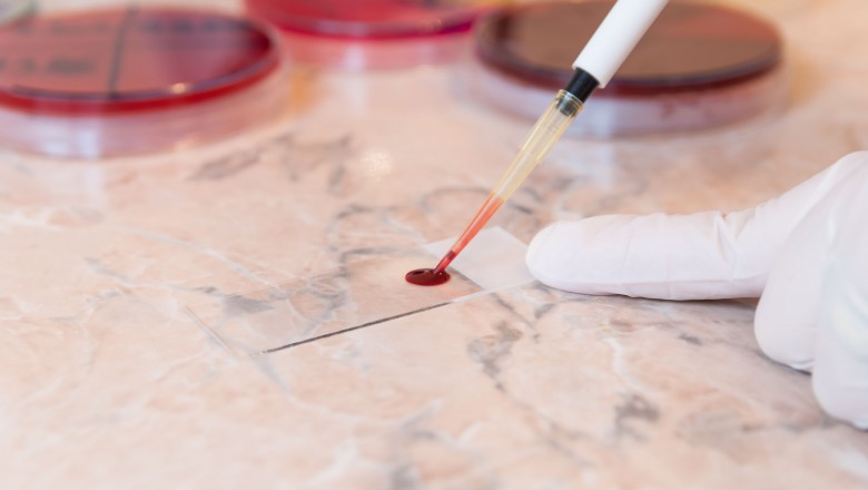Peripheral Blood Film Test: Everything that You Need to Know