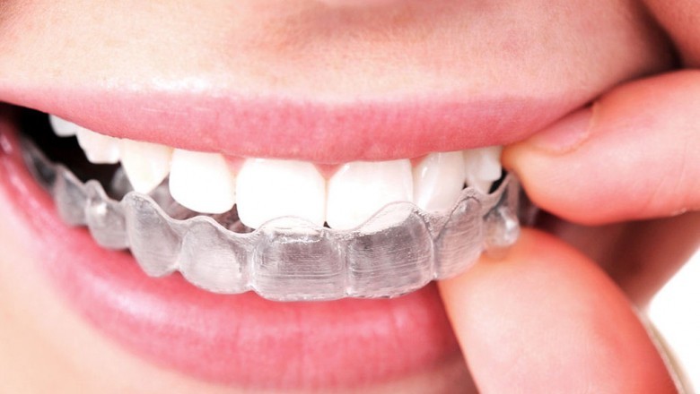 Boss Clear Aligner Therapy in Prosper TX