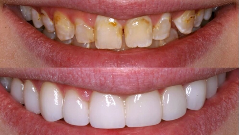 Porcelain Veneers Treatment in Prosper TX