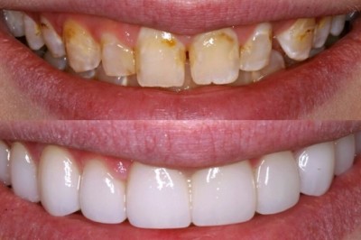 Porcelain Veneers Treatment in Prosper TX