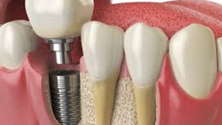 Dental Implants Livingston
