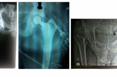 Your Best Partial Knee Replacement Surgery in Thane : Hip Replacement Surgeon In Thane