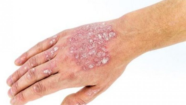 Need to know more about the psoriasis treatment in Ayurveda?