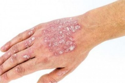 Need to know more about the psoriasis treatment in Ayurveda?