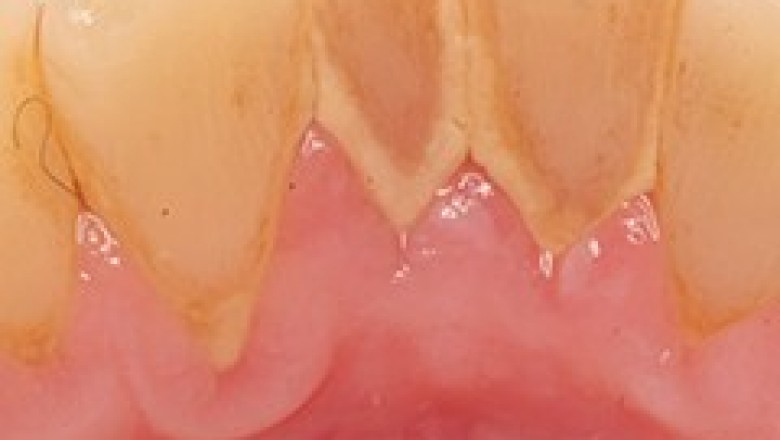 Calculus Teeth | Emergency Dental Services Mount Prospect