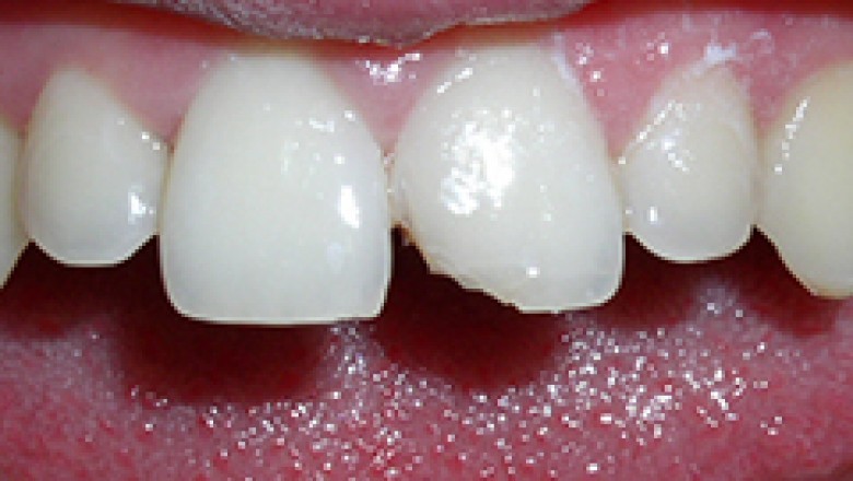 Chipped Tooth | Emergency Dental Services Woodridge