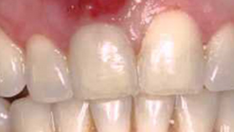 Tooth Abscess | Emergency Dental Services Morton Grove