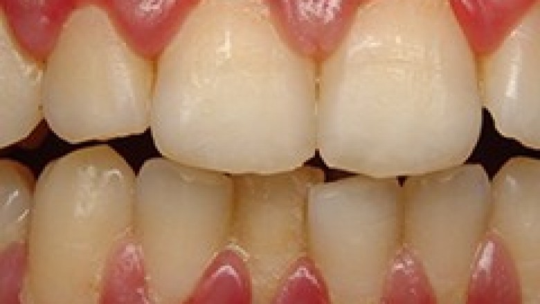 Gingivitis | Gum Disease | 24 Hour Emergency Dentists Gilbert