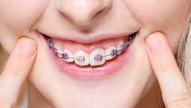How much do braces cost monthly?