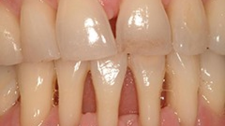 Gum Recession | Emergency Dental Service Phoenix