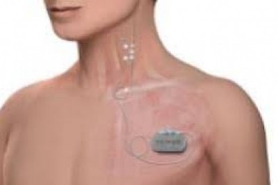 Global Vagus Nerve Stimulators Market Trends, Size, Forecast - 2019-2025