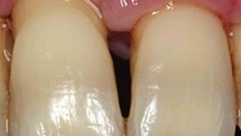 Periodontitis | Severe Gum Disease | Emergency Dental Service in Orange