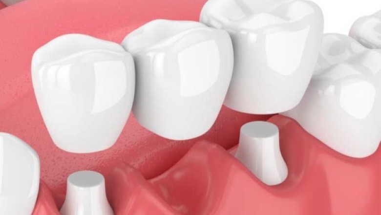 Teeth Replacement Options for Full Mouth Restoration