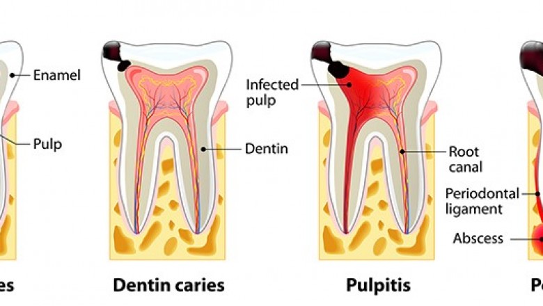 Dentist in Huntington Beach Says Root Canal Therapy Should be Your Last Choice, Not First