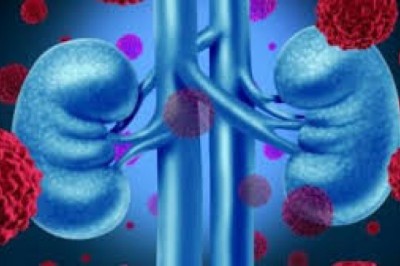 Global Kidney Cancer Market Trends, Size, Forecast - 2018-2023