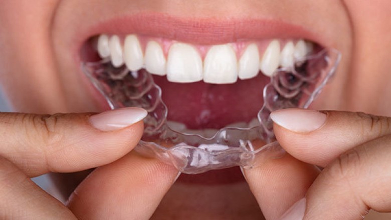 The Advantages of Invisalign over Traditional Metal Braces
