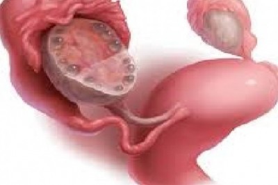 Global Polycystic Ovary Syndrome Market Trends, Size, Forecast - 2018-2023