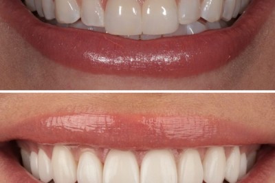 Porcelain Dental Veneers in West Hollywood at Smile Atelier